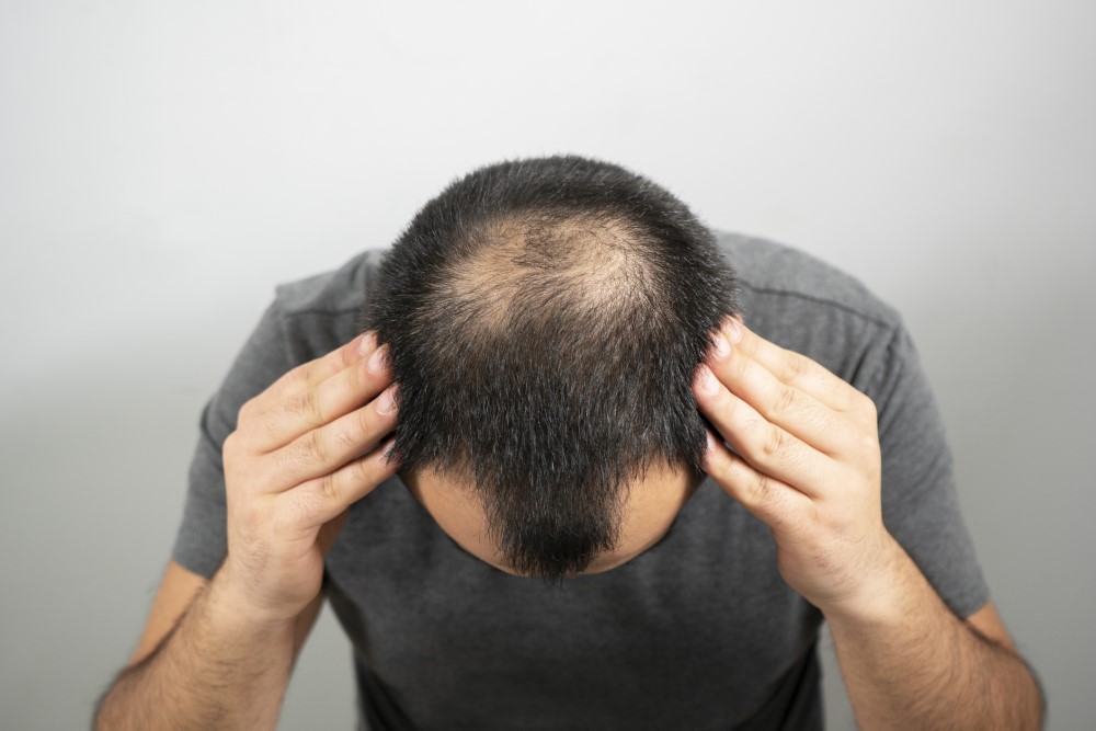 Journeys of Hair Loss Exploring Men s Experiences of Pattern